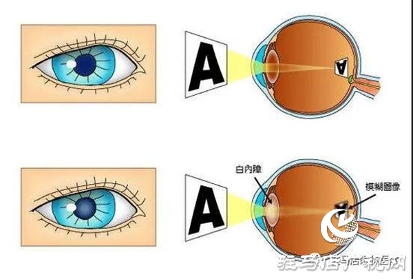  6·6愛眼日 | 關(guān)注普遍眼健康