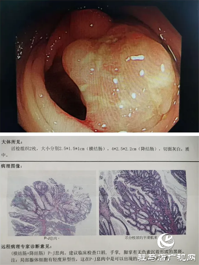 “黑痣”長在嘴上，息肉生在腸內(nèi)！市中心醫(yī)院專家為一罕見病患者內(nèi)鏡下切除30多處腸道腫物