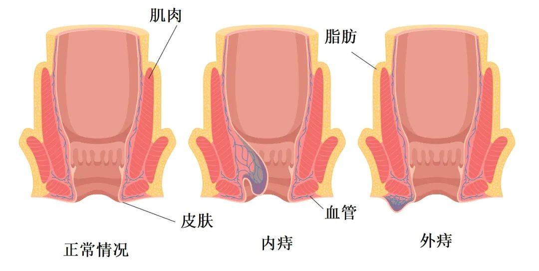 久坐的危害有多大？不只有血管功能下降、注意力不集中……