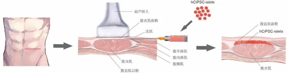 事關(guān)糖尿病治療，我國科學(xué)家取得突破